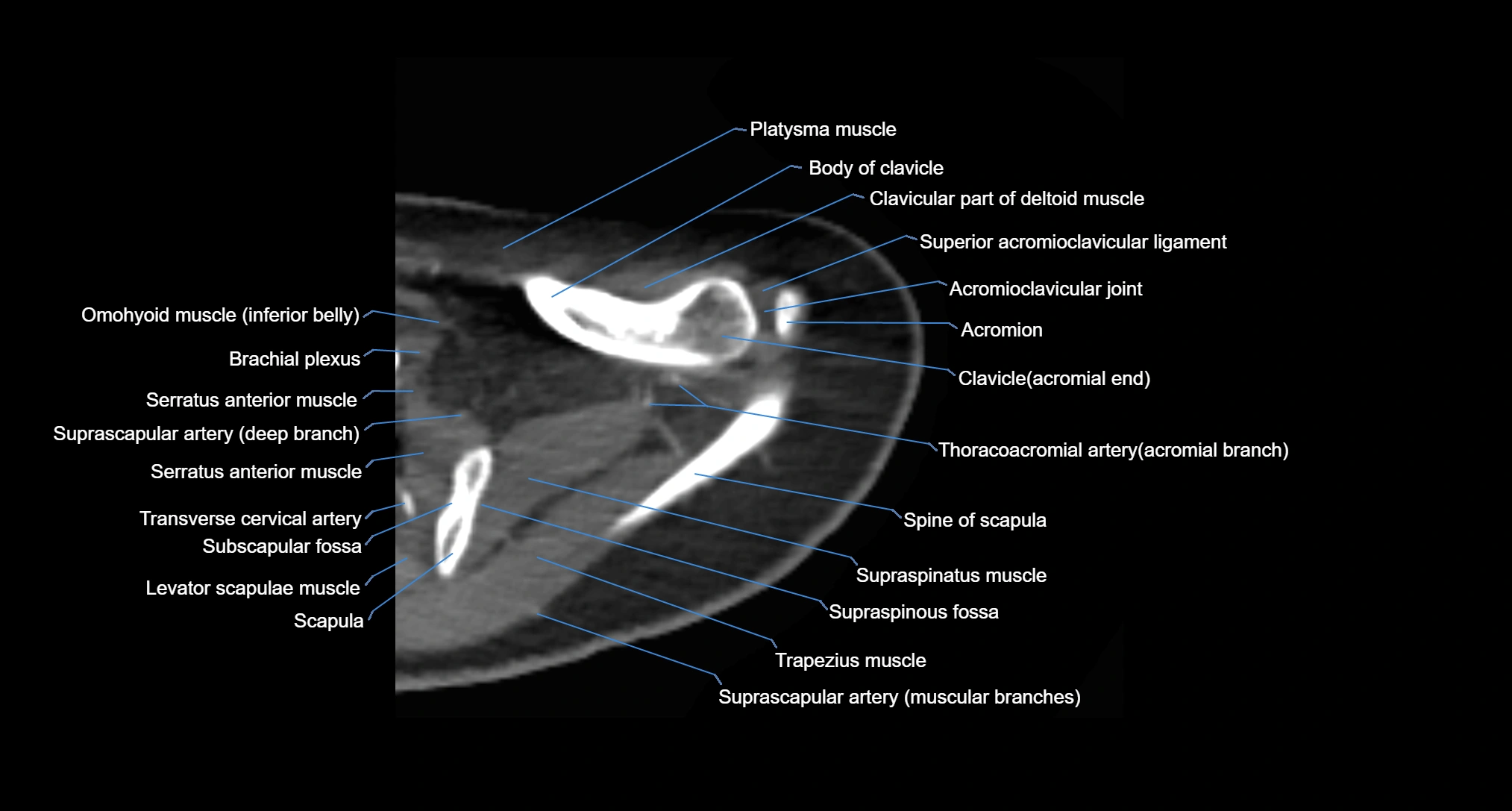 CT Shoulder axial cross sectional anatomy labelled radiology image -00014.webp